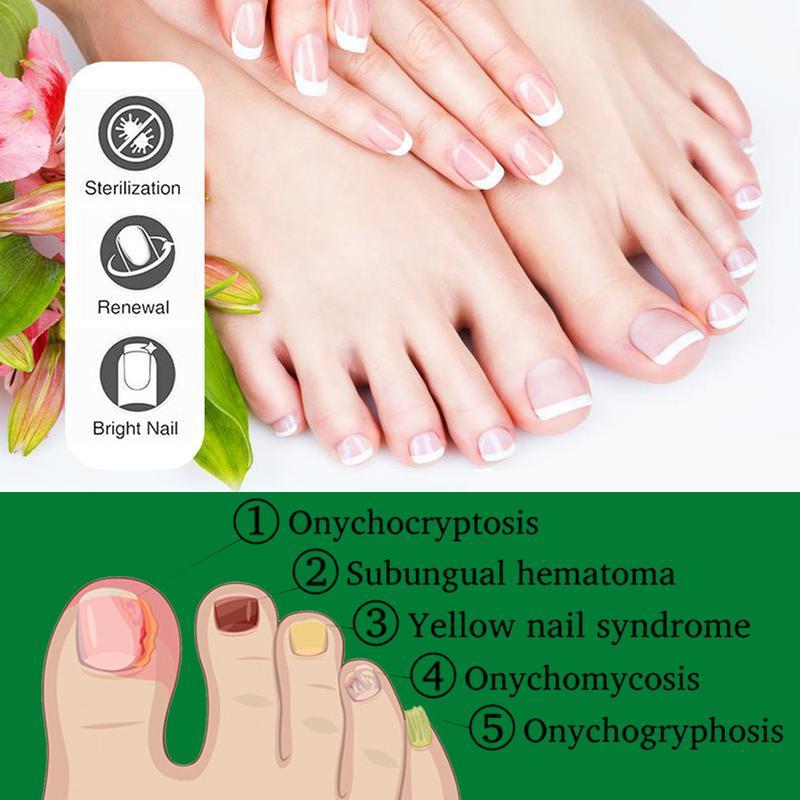 JAYSUING Ginger Nail Treatment Nail Support Nail Care Nail Polish Comfort