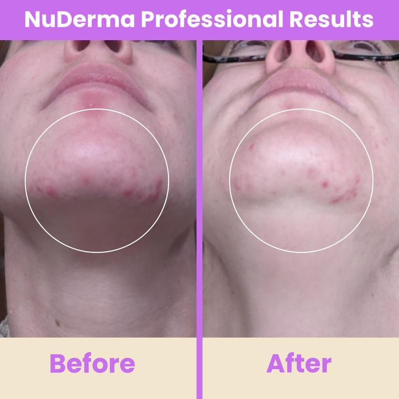 NuDerma Professional High Frequency Wand by Pure Daily Care with Argon and Neon Applicator for Anti-Aging and Anti-Acne