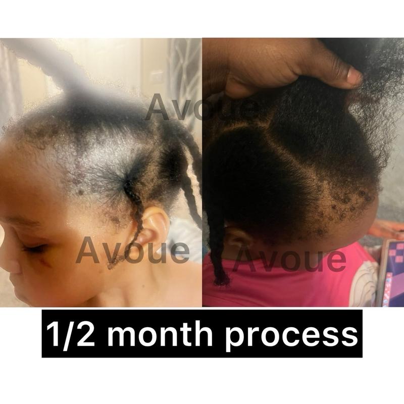 Unisex Hair Growth combo Anti Alopecia