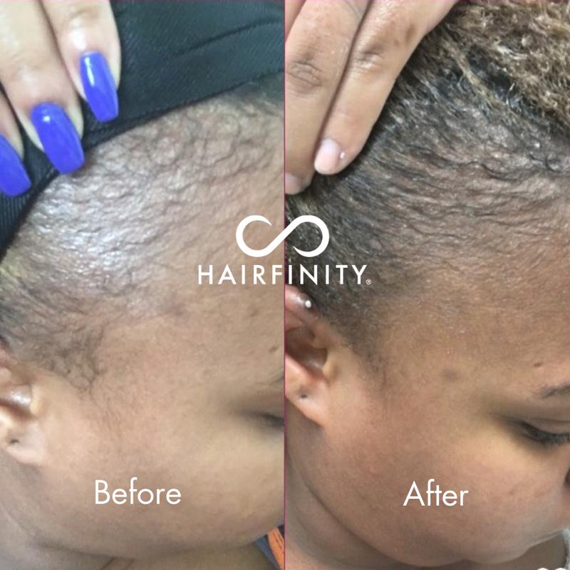 Infinite Edges Hair Serum | Treatment Targets Causes of Hair Loss | Revitalize, Strengthen & Protect Your Hairline | Sulfate & Silicone Free