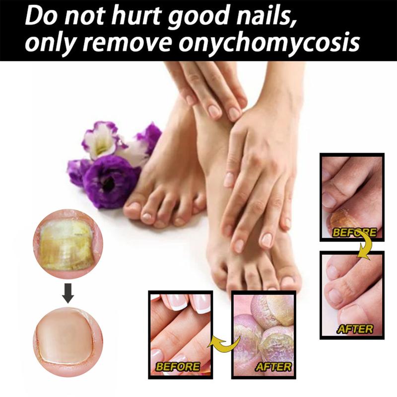 EELHOE Nail Repair Solution Thickening Bright Nails Remove Onychomycosis Dead Skin Repair Moisturizing Nail Art Nutritional Care Solution