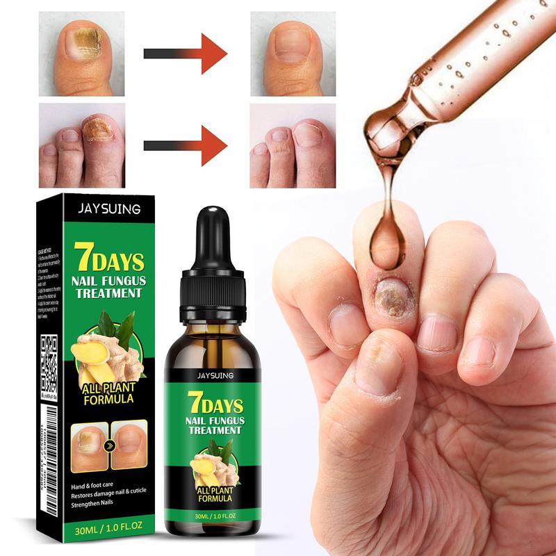 Ginger Nail Treatment Nail Support Nail Care, 7days Nail Fungus Treatment, Ginger Nail Treatment Oil, Ginger Nail Treatment Oil, Ginger Nail Serum, Ginger Nail Growth Oil (2PCS)[zjxhy809cy01]