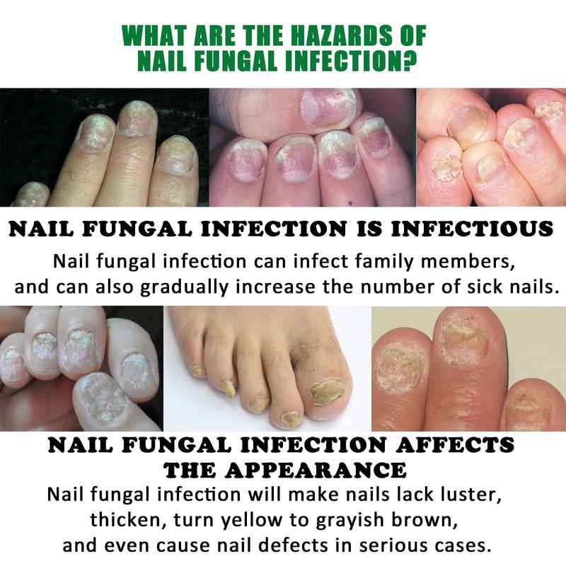 Ginger Nail Treatment  Multi-Purpose Nail Repair Solution for Discolored and Damaged nail oil