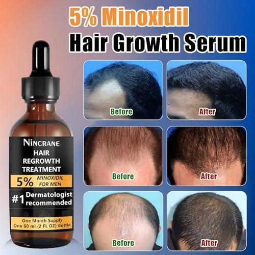 Nincrane 5% Minoxidil for Men Hair Regrowth, Beard Growth Kit, Extra Strength Minoxidil Beard Oil, Topical Hair Serum for Hair Loss & Thinning, Complete Beard & Hair Growth Solution