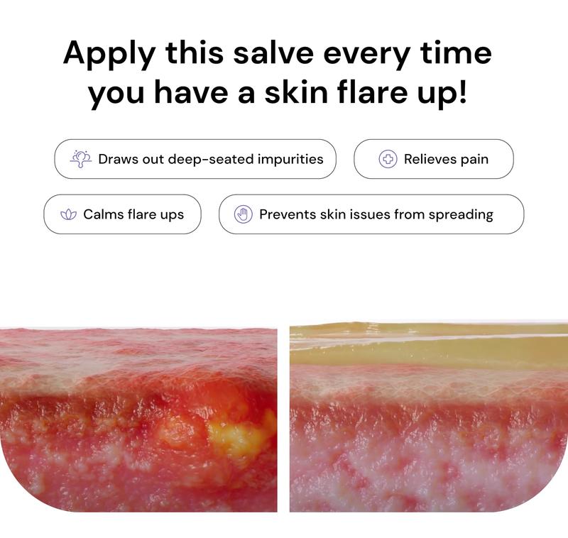 Universal Skin Healer | All Natural Flare Care | Eczema, Dry, Irritated and Cracked Skin | Made with Egg Yolk Oil and Propolis (4oz)