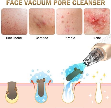 Blackhead Remover Pore Vacuum Kit - 2024 Upgraded Blackhead Extractor Tool with 3 Adjustable Suction Levels, 5 Probes, USB Rechargeable, Suitable for Women and Men,Delivery 3-7 days Facial Comfort